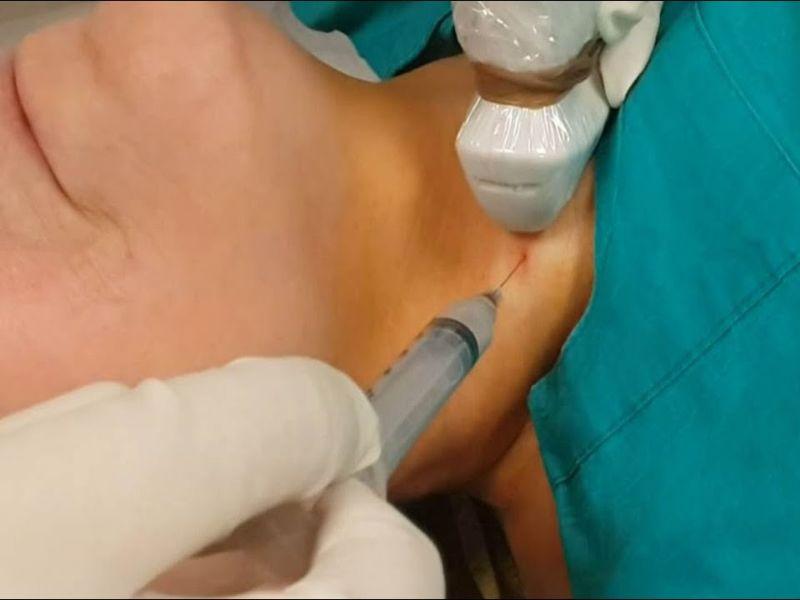 Ultrasound-guided ethanol ablation of a thyroid cyst in Auckland